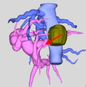 Related Image -Laparoscopic Segment 1 with Partial IVC Resection in Advanced Cirrhosis How to Do It Safely