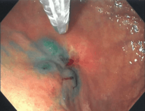 Fluorescent-Image Guidance in Robotic Subtotal Gastrectomy
