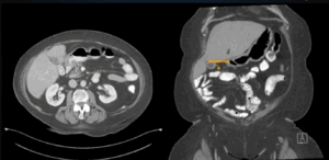Superior Mesenteric Vein-First Approach for Robotic Salvage Surgery with Indocyanine Green Fluorescence Angiography
