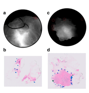 Feasibility Study of a Novel Protease-Activated Fluorescent Imaging System for Real-Time, Intraoperative Detection of Residual Breast Cancer in Breast Conserving Surgery