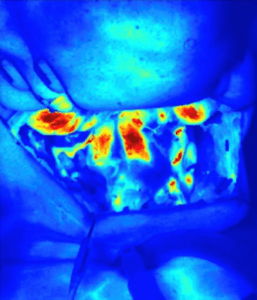 Intraoperative Fluorescent Angiography